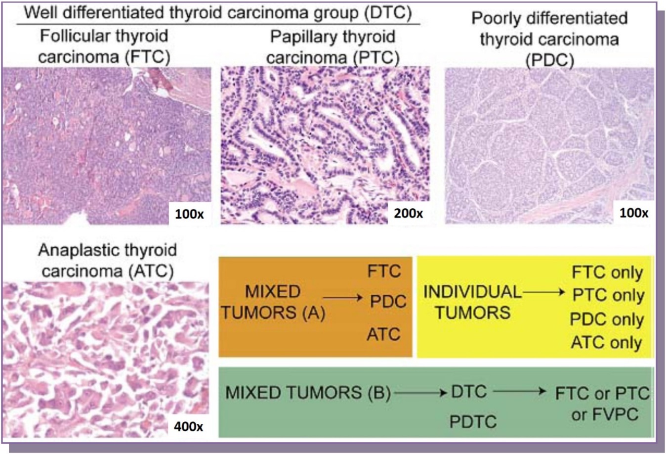 Representative histologies of well-differentiated thyroid carcinomas (follicular & papillary thyroid carcinomas, 100x and 200x magnification respectively), poorly differentiated thyroid carcinoma (100x) and anaplastic thyroid carcinoma (400x) are shown. Cases were selected which either had a well-differentiated component, a mix of two tumors (well-differentiated and poorly differentiated, set B) or a mix of three (follicular carcinoma, poorly differentiated and anaplastic carcinoma, set A)