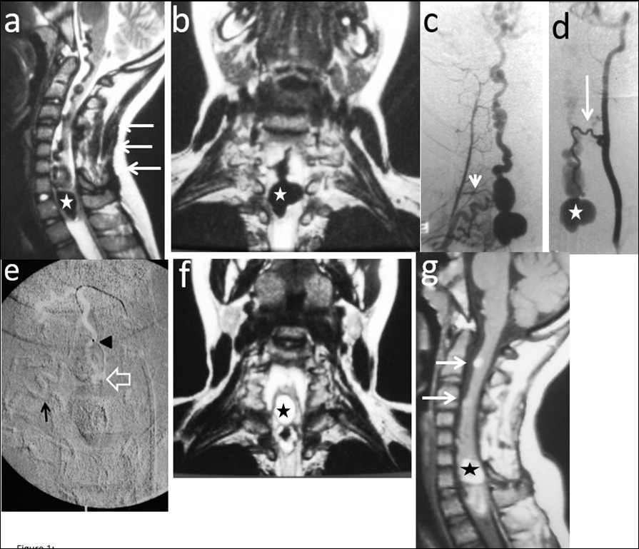 Case # 1: a) T2W sagittal and b) coronal MRI images showing a large bilobed varix in the anterior aspect of the spinal cord at the vertebral levels of C7 and T1 (star). Notice the large venous drainage ascending ventrally from the cervical spinal cord towards the brainstem (thin arrow). A previously C3 to C7 “decompressive” laminectomy was performed (arrows). c) Right thyrocervical trunk demonstrates that the main feeder to the fistula is the right artery of the cervical cord enlargement (short arrow). d) Another feeder from the ASA, branch of the left vertebral artery is visualized (thin arrow). The venous varix is shown (star). e) Roadmap image at the time of micro catheterization of the left ASA. The tip of the microcatheter (arrowhead) was further advanced to the fistulous site (open arrow) and 0.8 cc of 90% n-bca in lipiodol was injected. Also notice the glue cast injected in the artery of the cervical enlargement (thin arrow). f) MRI T2W FLAIR coronal and g) sagittal (postoperative day 5) showing fresh clot in the venous varix (star) with retrograde thrombosis of the ascending draining veins (arrows). The MR signal of the spinal cord remained normal.