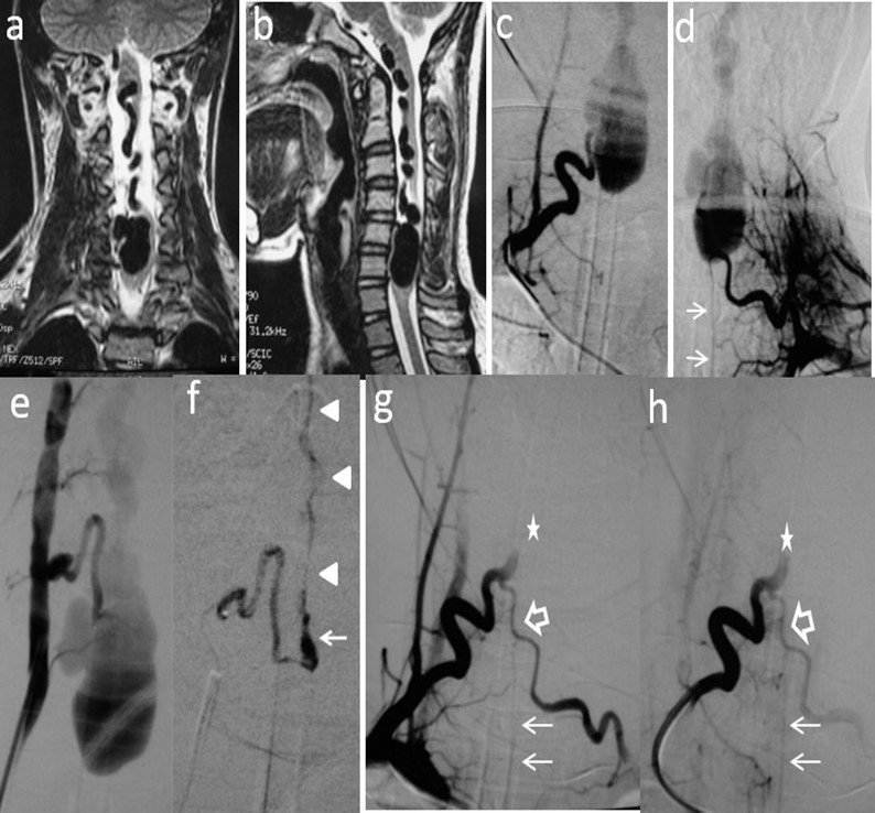 Case # 2: a) Coronal and b) sagittal T2W MRI shows large venous varix compressing ventrally the cervical cord at C5-C6 levels causing moderate central hyperintensity above, and mild below the cervical cord. Ascending convoluting draining veins reach the brainstem. c) d) and e) Angiograms showing right and left arteries of the cervical enlargement as well as a PSA of the right vertebral artery. All of them converge and shunt the varix at the same fistulous point. The ASA branches off the left artery of the cervical enlargement (thin arrows). f) DSA shows the right PSA feeder catheterized proximally. An injection of 30% n-bca in lipiodol was performed reaching the fistulous point (arrow). A thin layer of glue cast is seen in the lateral wall of the ascending vein (arrowheads) g) and h) Post-embolization right ascending cervical artery angiogram showing an arterial blockade at the entry of the fistulous point (star) preserving its anastomosis with the contralateral artery (open arrow). Notice that by reflux, the left artery of the cervical enlargement fills the ASA (thin arrows). Four hours later, the patient suddenly developed quadriplegia probably due to venous and/or ASA thrombosis. Patient lost to follow-up after 2 months.