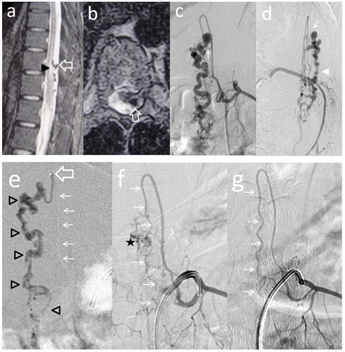 Case # 3: a) T2W MR sagittal and b) axial non contrast spinal MRI, showing flow voids in the dorsal aspect of conus and epiconus (open arrows) with hypersignal extending towards the lower dorsal spinal cord (arrowhead in a). c and d) Segmental left T11 angiogram in AP and lateral projections. The artery branches off to an enlarged ASA (Artery of Adamkiewicz) and also a thinner PSA feeding the PMAVF. The fistula is located posterolaterally (thin arrow in c) and d), draining downwards (arrowhead). e) Injection of 33% n-BCA with rapid microcatheter removal. See the tip of the microcatheter in the curve of the PSA (open arrow). The glue reached the fistulous site and the draining vein (open arrowheads) f) Left T11 angiogram following embolization did not show any shunt and only remnants of the abnormal draining veins were seen (star) with preservation of the ASA axis (thin arrows). g) An angiogram performed 3 months postembolization demonstrated complete eradication of the AVF and preservation of the artery of Adamkiewicz (thin arrows).