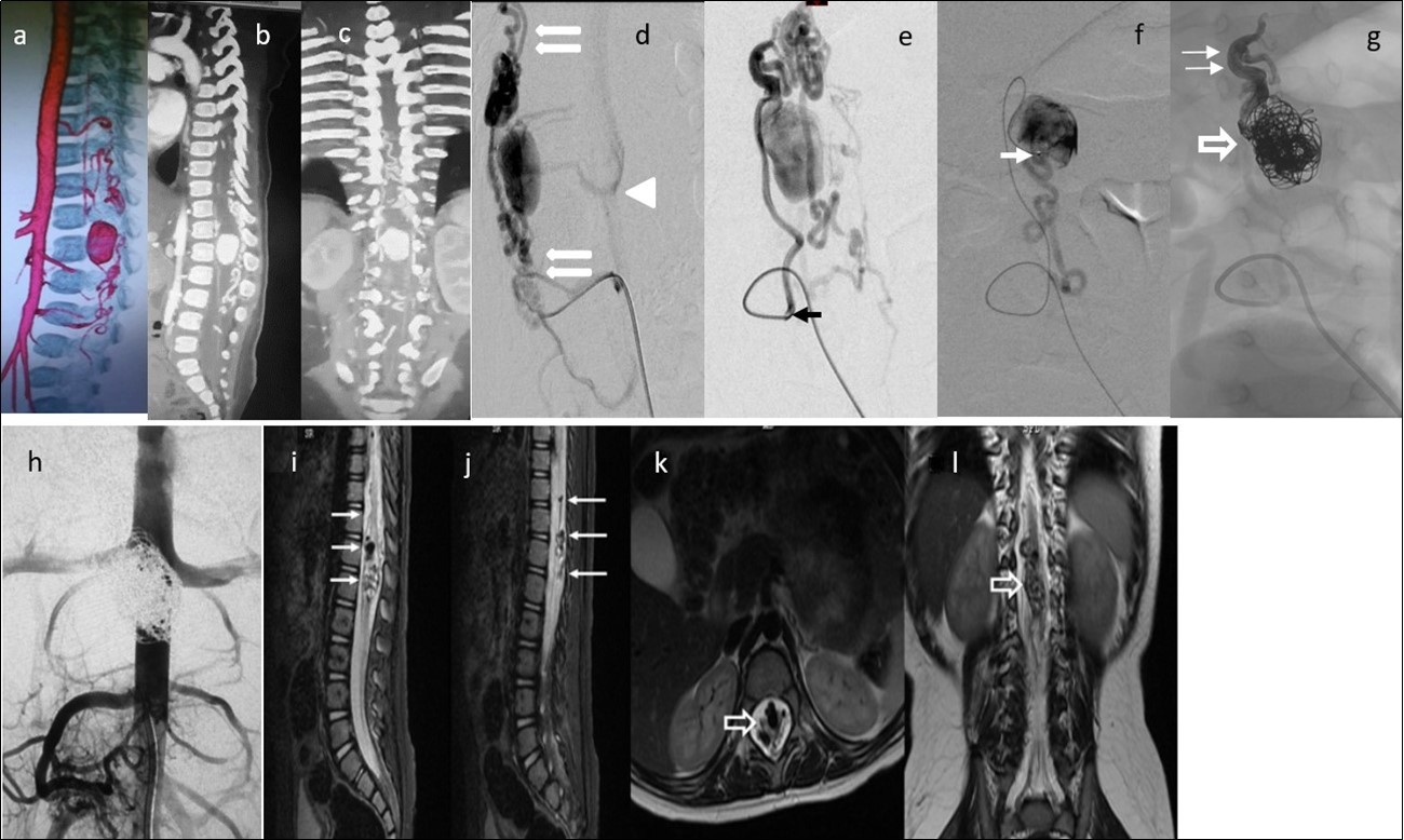 Case 4: a) 3D CTA shows a gigantic venous pseudoaneurysm occupying the spinal canal at the T12-L1 vertebral levels with tortuous veins above and below the lesion. b) and c) 2D reformatted images. d) and e) Selective right L3 angiogram through a 4F guiding catheter (arrow) in lateral and AP projections showing an enlarged PSA feeding a huge venous varix with ascending and descending perimedullary veins (thin arrows) and with segmental epidural draining veins at the fistula level (arrowhead).f) A microcatheter was navigated up to pseudoaneurysm (arrow) g) In the venous sac, 21 GDC coils were deployed (open arrow) and the microcatheter tip was pulled back to the fistulous site followed by Onyx 18 injection to fill up the foot of the ascending draining vein (thin arrows). h) Post-embolization abdominal aortogram (late phase) failed to demonstrate any remaining shunt. i) to l) Multiplanar T2 MR images 6 months’ post-embolization showing absence of flow, and artifacts due to coils and Onyx (arrows). No spinal cord hyperintensity was observed. Patient starting to walk independently with minimal right foot dorsiflexion paresis. He gained complete sphincter control.