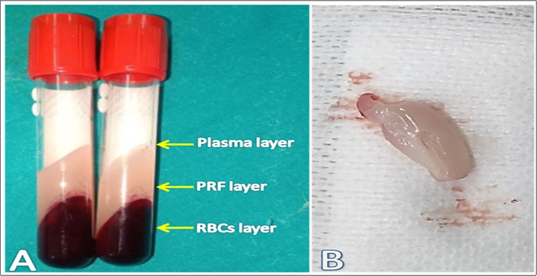 Preparation of autogenous PRF. A: The blood in a plain tube was separated into three distinct layers where the middle layer, a strong fibrin clot, represents the leukocyterich PRF. B: A clean yellowish white PRF clot was obtained after whipping the adhered RBCs layer off on a sterile gauze pad.