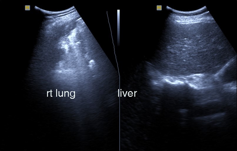 Chest ultrasound showing right lung segmental consolidation with positive air bronchogram.