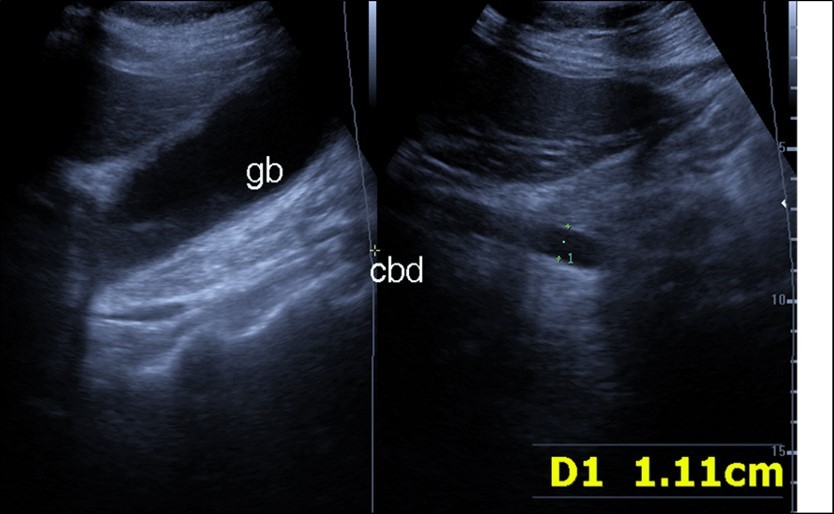 Real time ultrasound showing thickened wall of gall bladder (gb) with dilated Common bile duct (cbd) in patient with severe Covid-19.