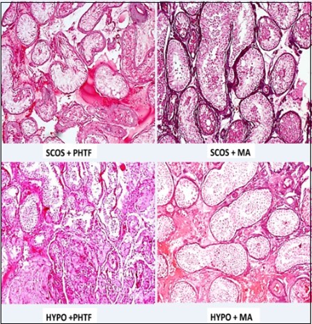 Photomicrographs of different mixed histologic patterns