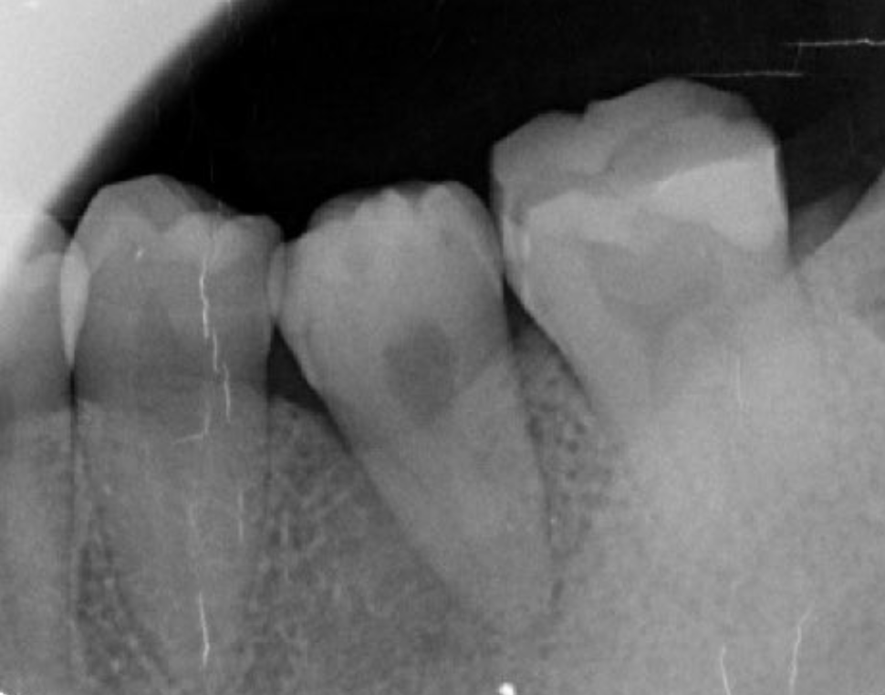 Clinical case of left autotransplantation. Extraction of #38 was performed without causing damage to the periodontal ligament, which was found to be abundant.