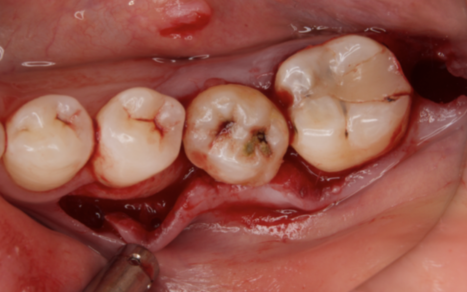 Dental X-ray image obtained after autotransplantation from #38 to #36. The donor tooth root canal appeared to be blanched.