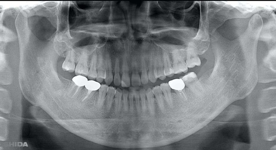 Intraoral photo after placement of definitive prosthesis.
