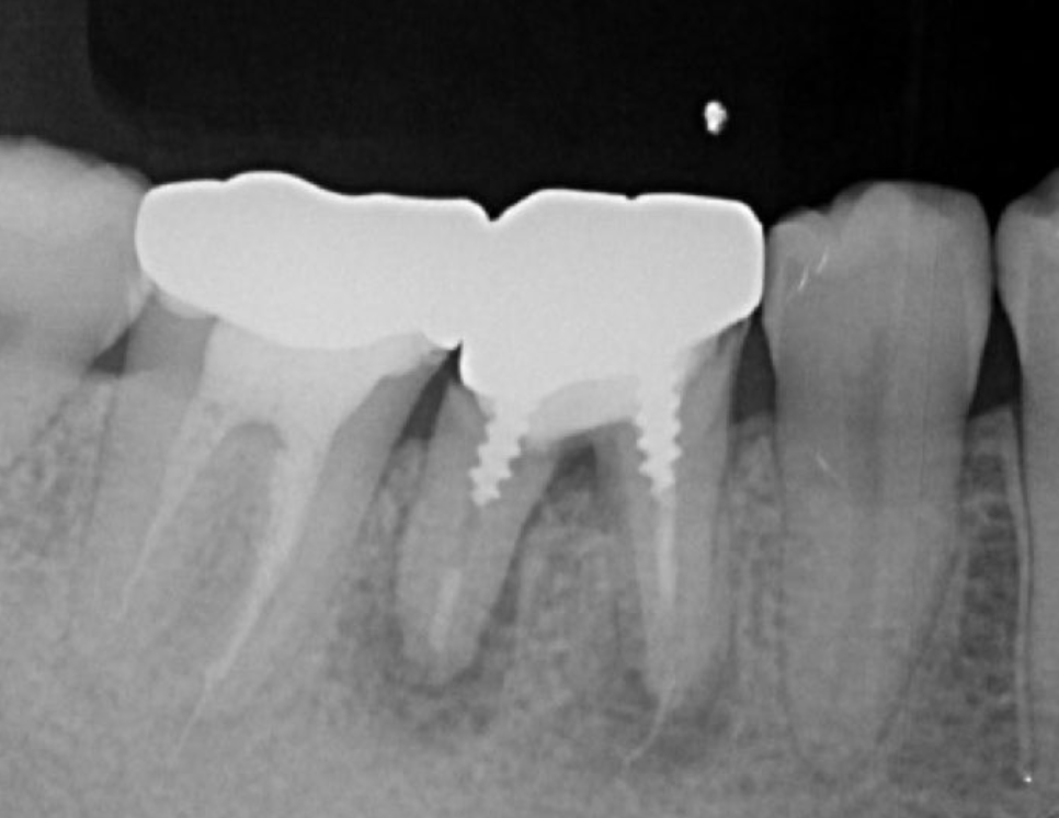 Pre-treatment X-ray findings. A cystic lesion was found in the mesial and distal roots apex, and root nodule of #46.