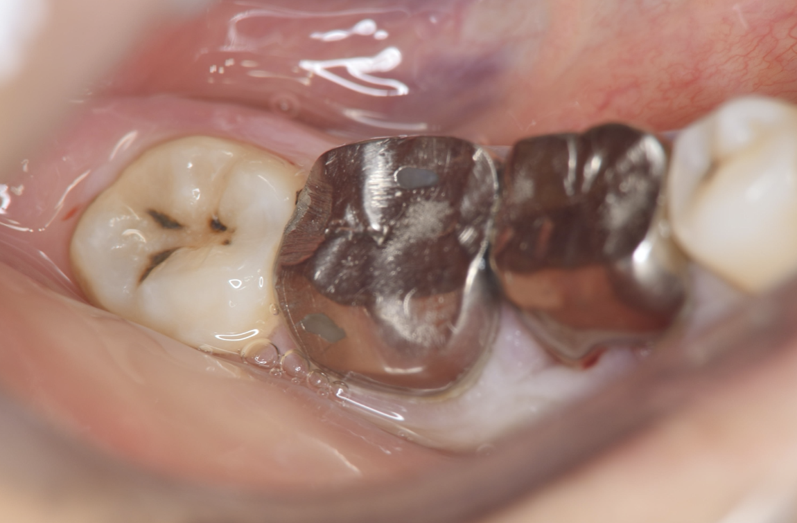 Preoperative intraoral findings. A metal crown was inserted at #46 and bleeding on probing during the periodontal pocket examination was noted.