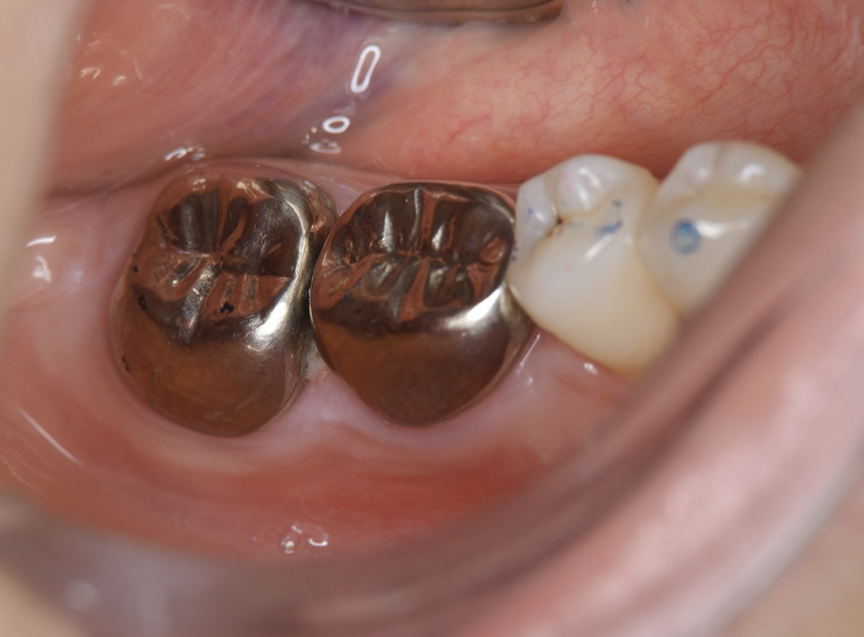 Inter-oral photo obtained after treatment. Full metal crowns were inserted for #46, #47. Pathological mobility and bleeding on probing were not seen, and the transplanted tooth showed good function.