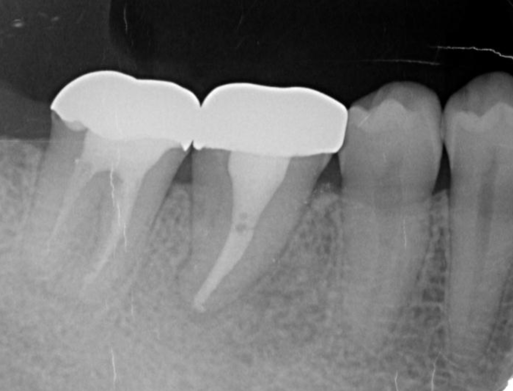 Cone beam CT image obtained after transplantation. Bone regeneration around the grafted tooth was confirmed.