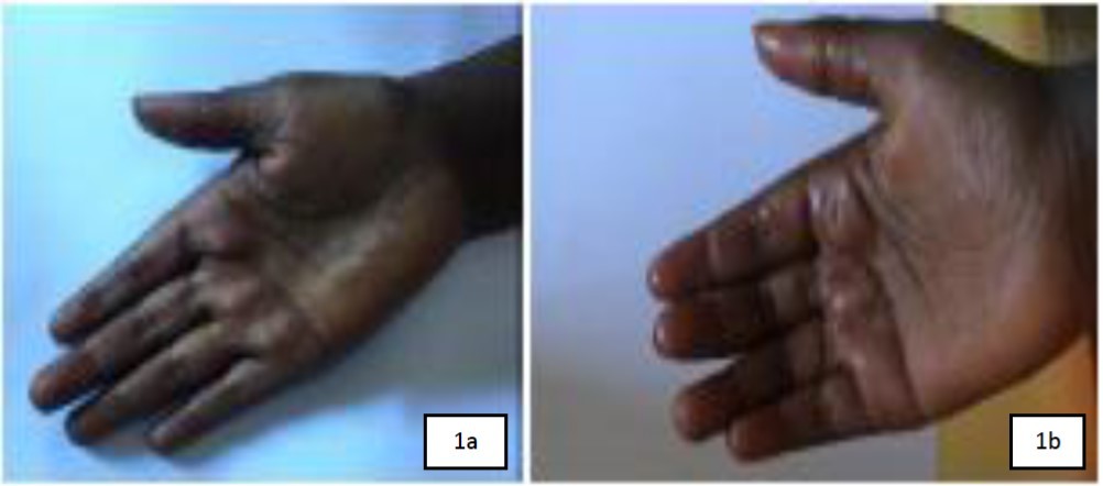 Melanoderma (1a) ; normal skin appearance after treatment (1b)