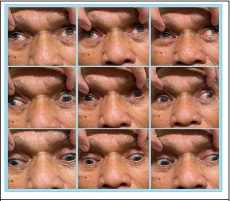 Bilateral exotropia on primary gaze exotropia and bilateral adduction deficit during version
