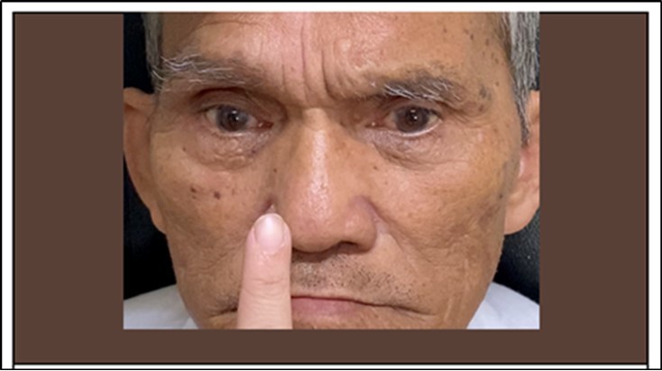 No convergence of both eyes were noted