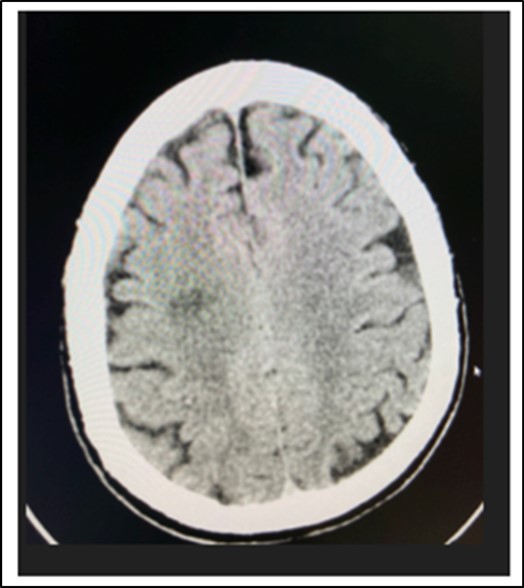 Cranial CT Scan plain, axial of the patient done 6 hours after onset of diplopia, shows a hypodense focus in the sub cortical region of the right centrum semiovale extending to the right corona radiata
