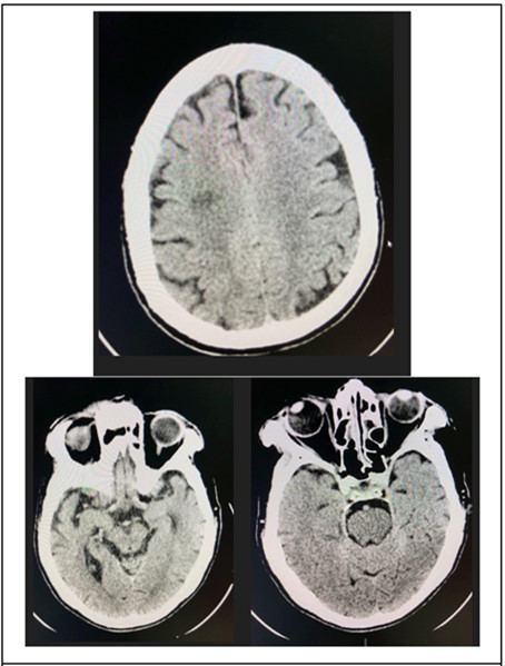 Cranial CT Scan plain, axial with orbital cuts of the patient which shows un remarkable orbit, midbrain and pons findings.