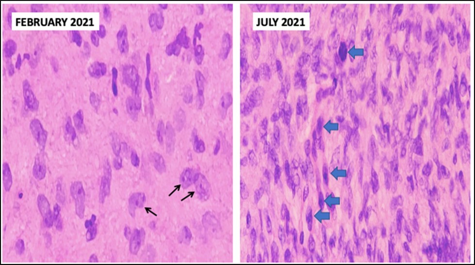 Comparison between biopsies taken five months apart. The histopathology in the biopsy done in February shows well-spaced uniform cells (black arrows). The biopsy done in July shows cellular congestion with atypical, pleomorphic cells with increased mitotic activity (blue arrows).