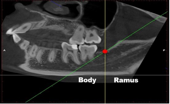 Image-reading position. (1) a horizontal line was made parallel to the lower edge of the mandible (grey line); (2) a tangent line of the front edge of the mandibular ramus (green line), which intersects with the upper edge of the mandibular body (Fig. 1, red circle); (3) a line across the intersection was made vertical to the line in (1) (Fig. 1, yellow line). We defined the following: the bifurcation that appears in front of this vertical line (yellow line) is classified into mandibular body area, whereas the bifurcation that appears behind it is the mandibular ramus area (Fig. 1).