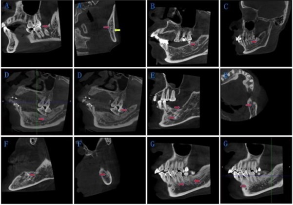 New classification of BMC: The red arrow points to the bifurcations, and the yellow arrow points to the mandibular canal. (A) Type IA: Bifurcations at the mandibular ramus, and retromolar foramen has been formed. (B) Type IB: Bifurcations at the mandibular ramus, and retromolar foramen has not been formed. (C) Type II: Bifurcations at the mandibular body. (D)-(F) Type III: Bifurcations exist both at the mandibular body and the mandibular ramus on one side. (G) Type IV: Other circumstances.