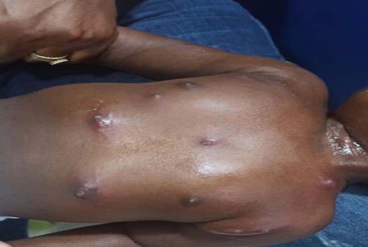 Umbilicated nodules on the chest, abdomen, axilla and neck