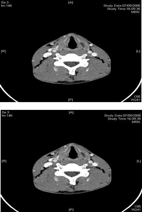 CT scan showing bilateral lamella expansions of the thyroid cartilage with cystic changes on the left