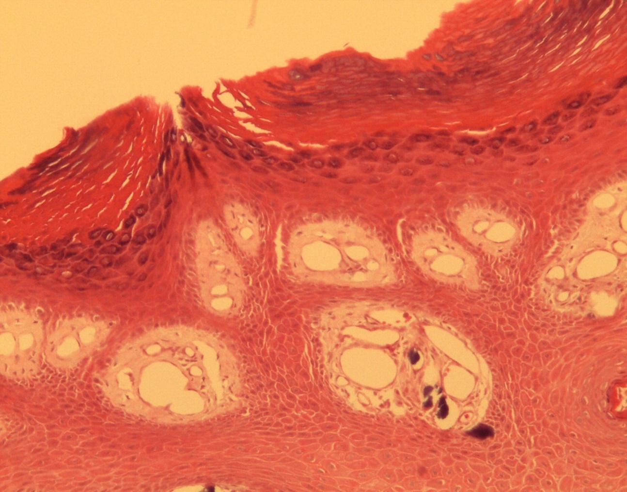 Common wart with calcium foci at the level of the dermal vessels grouped in lobules. HE. 200x.