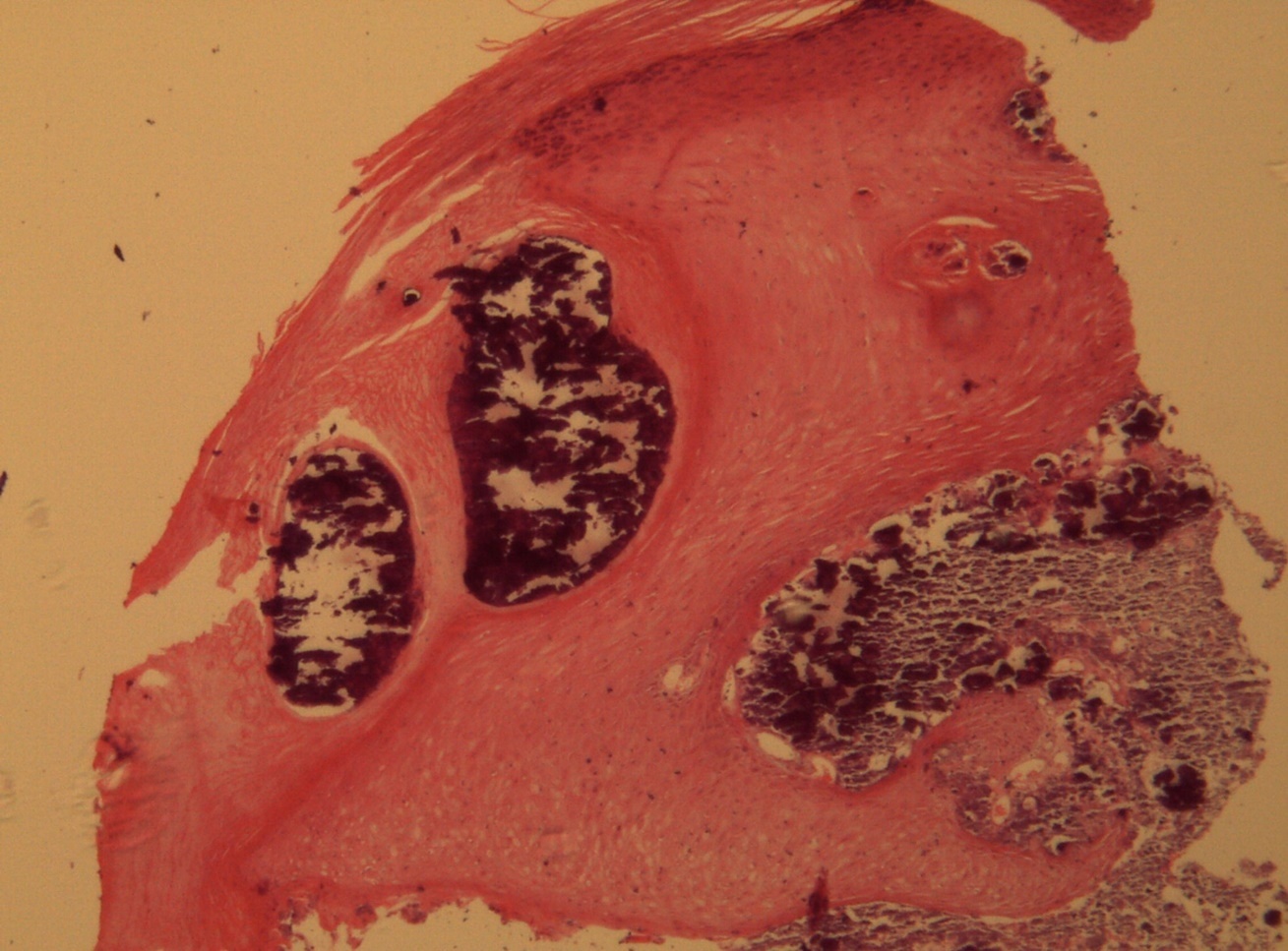 Relationship of calcium foci in the papillary dermis with the overlying epidermal hyperplasia. HE. 200x.