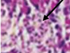 Photomicrograph of the pancreas from diabetic control (DC) rats showing distorted Islet margin (arrow) with lymphocytic cells infiltration and moderate necrotic parenchyma (H &E stain X400 magnification)