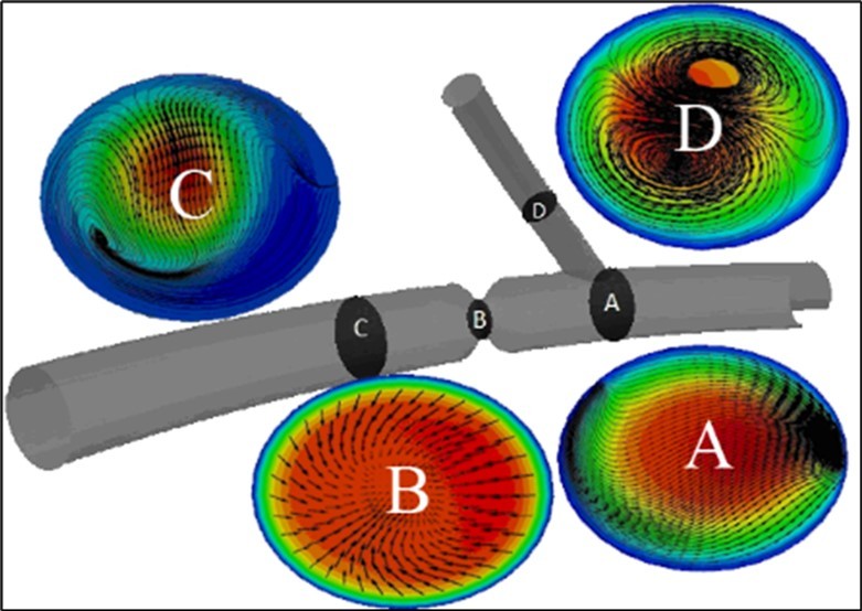 a)Contours of axial velocity of blood flow also streamlines of formed secondary flows, and b) axial velocity profiles of this fluid flow at different cross sections of the modeled ideal geometry of coronary arteries with a stenosis.