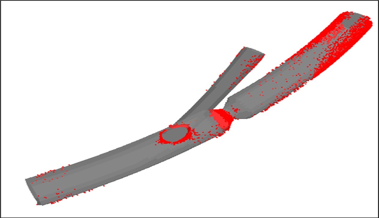 Deposition of LDL particles on the walls of the moving artery with the stenosis.