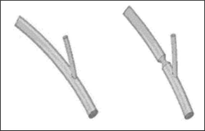 The ideal geometries of the modeled healthy bifurcation and the bifurcation with stenosis.