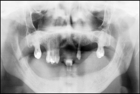First Visit Pre-operative radiograph
