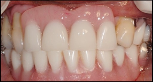 Patient applying occlusal force while metal housing caps are being secured into the denture