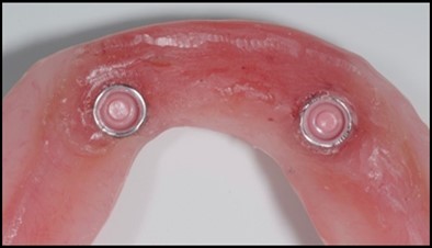 View of denture after being cleaned and polished