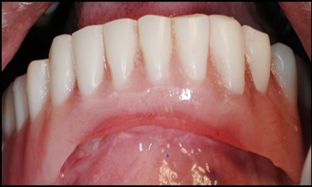 Insertion of the lower denture