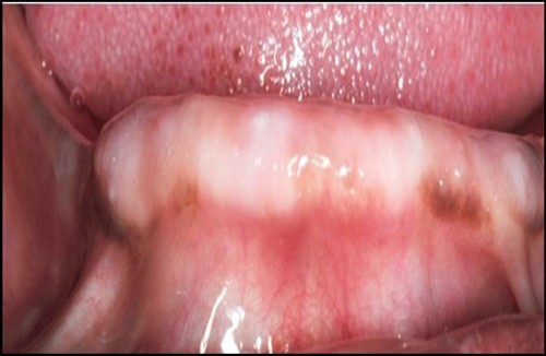 Prpre-operative view of anterior mandibular knife edge ridge.