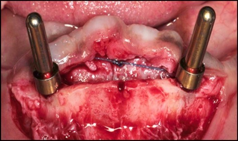 Paralleling pins in each pilot osteotomy indicating their position