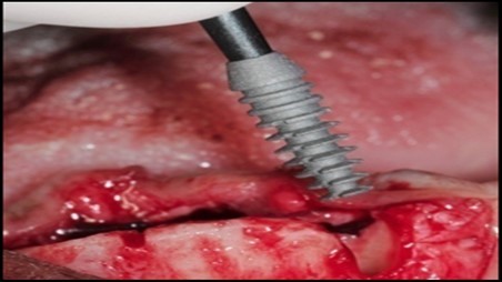 A 3.5mm x 11.0mm HA coated implant being inserted into the osteotomy in the area of the mandibular left canine