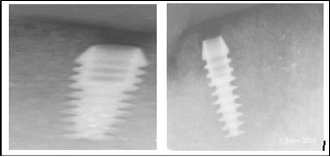a,b. Post-insertion radiographics in the mandibular area right,left,