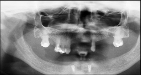 Panoramic radiograph after the insertion of two implants