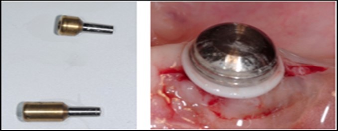 (A) View of 2.0mm and 5.0mm post Locator Abutments with a 2.0mm post. (B) Placement of the Locator Abutment after the well of implant has been cleaned with alcohol on a cotton-tipped applicator.