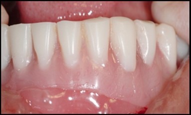 Denture being inserted