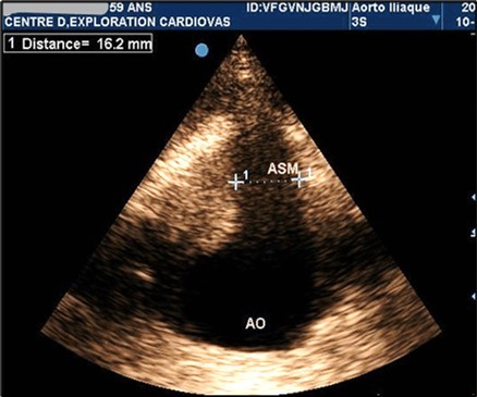 Partially thrombosed 5.2cm fusiform suprarenal AAA with extension to the superior mesenteric artery in a 59-year-old subject (CEC 'Saint-Esprit' of the AMP-MCV).