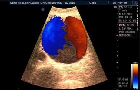 Large fusiform subrenal abdominal aortic aneurysm of 9.28cm thrombosed at 4/5 in an 82-year-old woman (CEC ‘Saint-Esprit’ from AMP-MCV).
