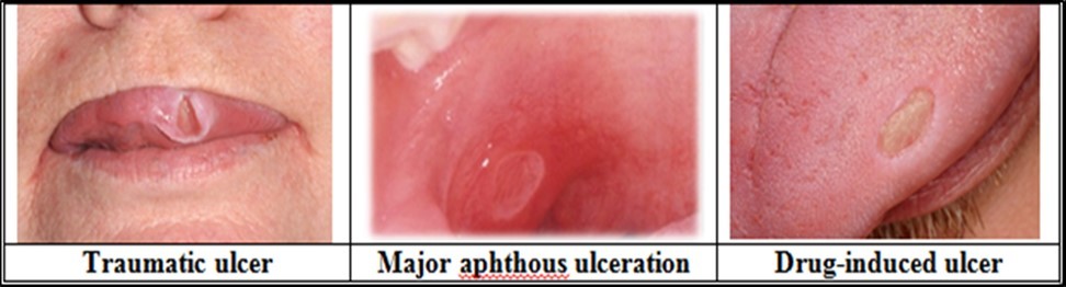 Clinical presentations of oral ulceration