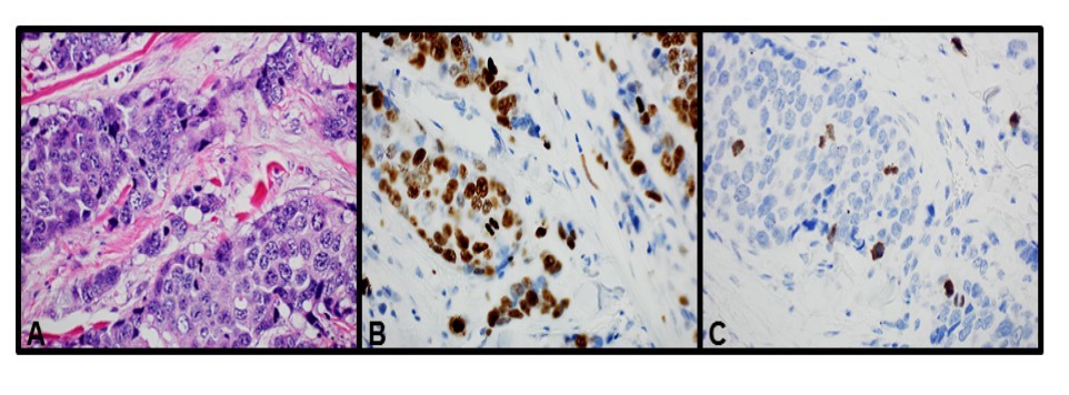Images of the tumor cells from the same area (400X). A: H&E stain. B: Ki-67 IHC stain. C: PHH3 IHC stain