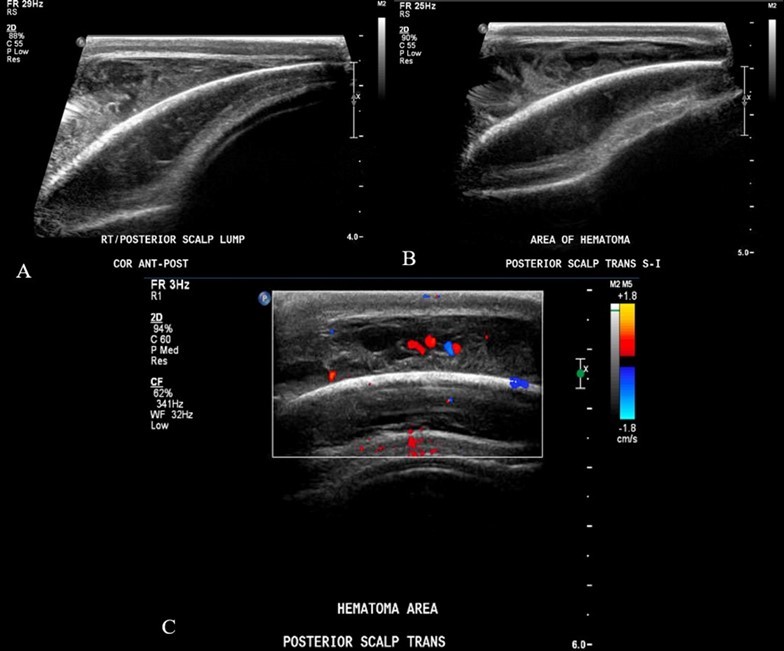 Ultrasound soft tissue head using multiplanar gray scale and color Doppler images. The superficial subcutaneous soft tissue appears homogeneous and uniform thickness. There is a layer of heterogeneous echogenicity deep to the subcutaneous layer, on the surface of the bone which appears retained by an echogenic capsule or membrane. This measures up to 9 mm greatest thickness. The size of the collection is greater than the transducer can measure. Additional images performed to include the edges of the hemorrhage show uplifting of the galea consistent with subgaleal location. The cranial sutures are not adequately included.