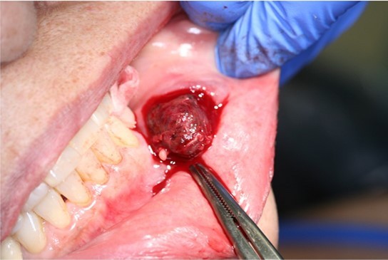 Intraoperative photograph of dissection of hemangioma from left cheek.