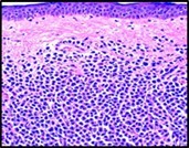 Cutaneous mastocytosis demonstrating a dermal infiltrate of atypical mast cells imbued with abundant, eosinophilic cytoplasm, minute granules and enlarged, pale nuclei. Mast cells appear intermixed with reactive inflammatory cells as histiocytes, lymphocytes and eosinophils. Stratified squamous epithelium is superimposed upon mast cell aggregates(8).